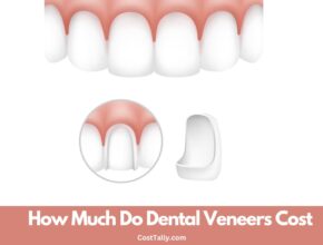 How Much Do Dental Veneers Cost