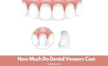 How Much Do Dental Veneers Cost