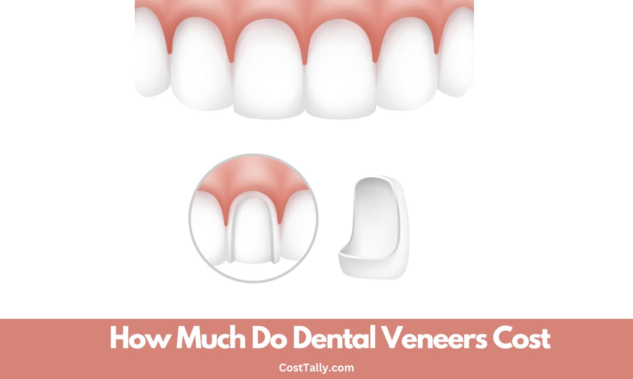 How Much Do Dental Veneers Cost